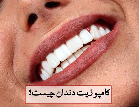 قیمت کامپوزیت دندان 1404 + شرایط کامپوزیت قسطی در تهران
