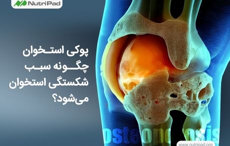 چرا سلامت استخوان‌ ها در سنین پایین به چالشی جدی تبدیل شده است؟