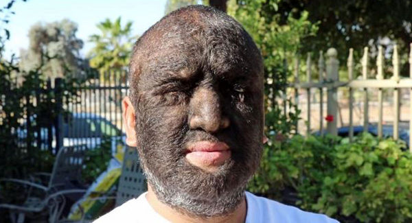 ۹۸ درصد بدن این مرد با مو پوشیده شده است