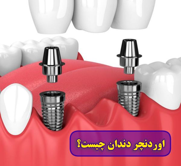 اوردنچر دندان چیست؟ (هزینه دست دندان کامل اوردنچر)