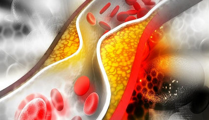 ۷ علامت هشداردهنده کلسترول بالا در ناخن 