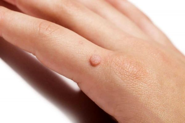 چگونه «زگیل» را درمان کنیم؟