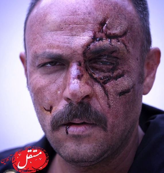 عکس زخم صورت بازیگر معروف +16
