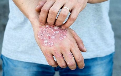 نسخه ای برای سوریازیس 