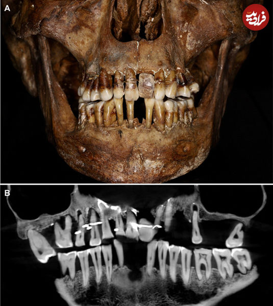 تصویر زنی که ۴۰۰ سال قبل دندانهایش را «سیمکشی» کرده بود