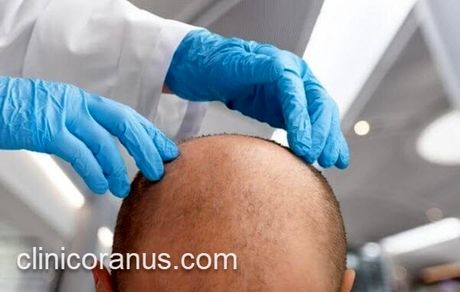 کاشت مو در جنت آباد

